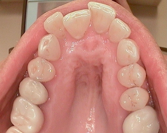 before of upper teeth straightening