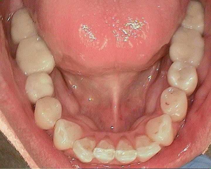 before of lower teeth straightening