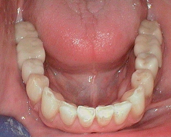 after of lower teeth straightening