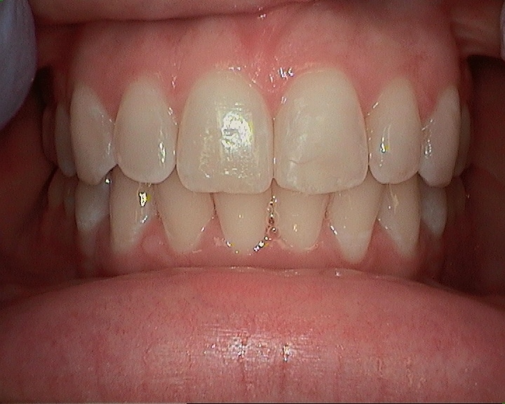 after of sasha teeth