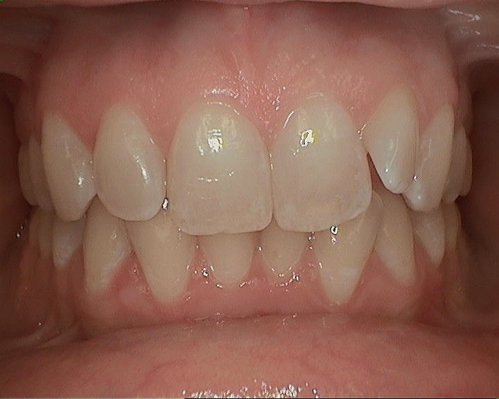before of sasha teeth